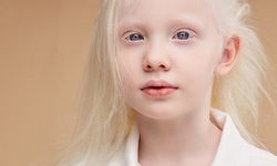 Albinizm hakkında ne biliyoruz?