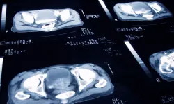Prostat kanseri denemesi: Radyoterapi dozları güvenli bir şekilde azaltılabilir