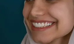 Etimesgut Gülüş Tasarımı İçin Hangi İşlemler Uygulanır?
