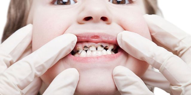 Doç. Dr. Barış Karabulut: “Süt dişleri kalıcı dişlerin rehberidir”