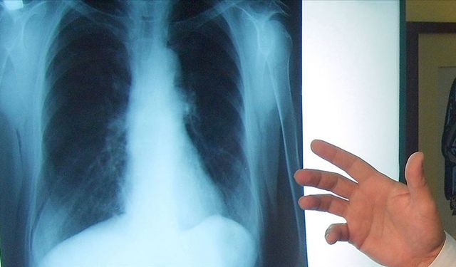 Türkiye'de yılda ortalama 41 bin kişi akciğer kanserine yakalanıyor