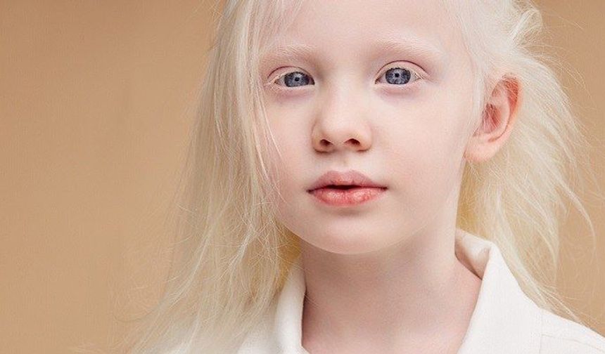 Albinizm hakkında ne biliyoruz?